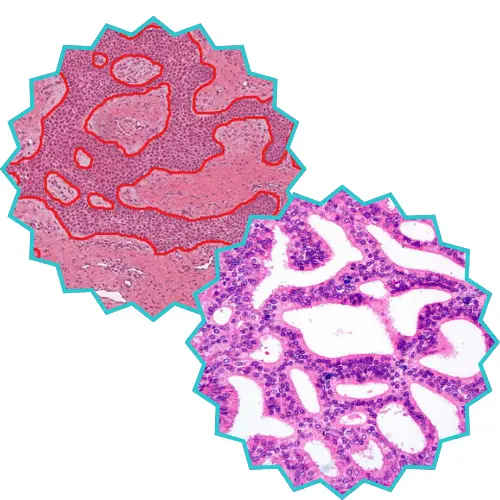 histopath annotations, ai in healthcare, data annotations, mitotic body anlaysis